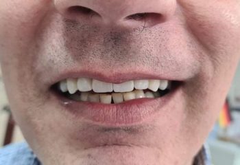 ИМПЛАНТО ПРОТЕТИКА В ГОРНА ЧЕЛЮСТ