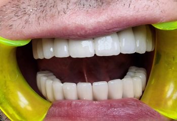 Това тотално възстановяване бе осъществено при използване на лазер, озон, регенерация на коста и импланти, пациента нямаше достатъчно кост следствие на авансирана пародонтоза.