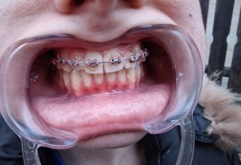 Резултатите след 2г лечение .Тази пациентка беше спасена от серийни екстракции на 4 премолара (предлагани от всички видни светила в ортодонтията)като задължителен елемент в ортодонтското лечение! Е тайна е как ,но можете да преброите зъбите:)