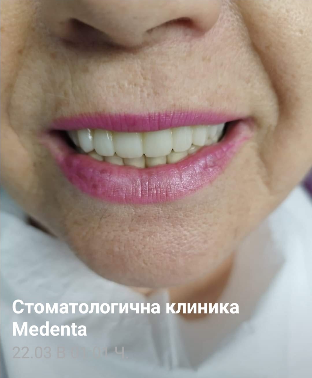 73г пациентка, лечението извършено от д-р Койнов Медента Плевен